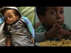 Malnourished children, a face of the crisis in Venezuela